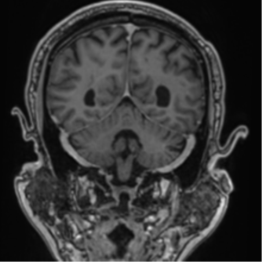 Atypical meningioma (WHO grade II) with brain invasion (Radiopaedia 57767-64729 Coronal T1 C+ 60).png