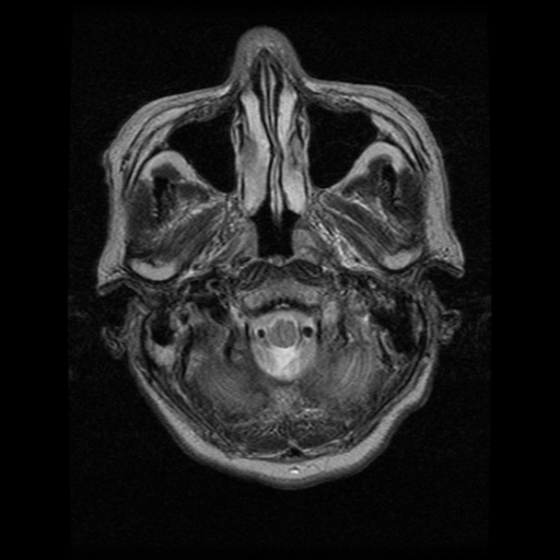 File:Atypical meningioma (WHO grade II) with osseous invasion (Radiopaedia 53654-59716 Axial T2 2).png