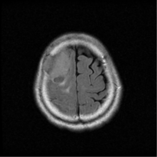 File:Atypical meningioma with skull invasion (Radiopaedia 34357-35648 Axial FLAIR 19).png