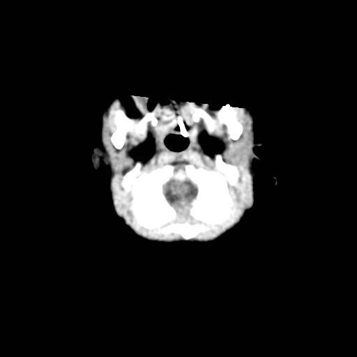 File:Atypical teratoid rhabdoid tumor (prenatal US and neonatal MRI) (Radiopaedia 59091-66387 Axial non-contrast 7).jpg