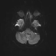 File:Autoimmune limbic encephalitis (Radiopaedia 30363-31005 Axial B0 and DWI 40).jpg