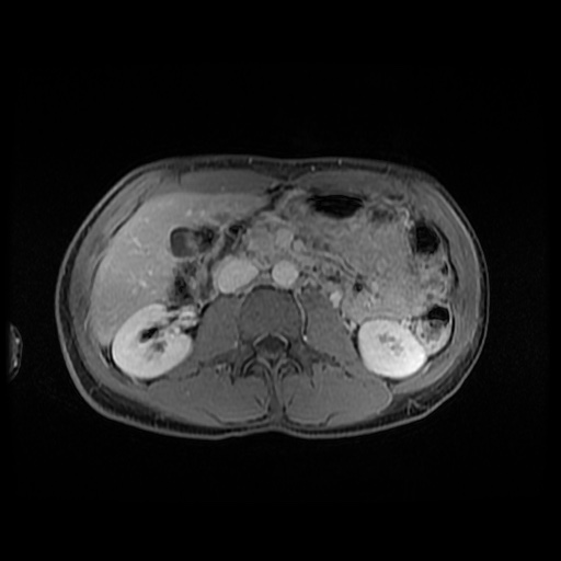 File:Autoimmune pancreatitis (Radiopaedia 69751-79729 N 81).jpg