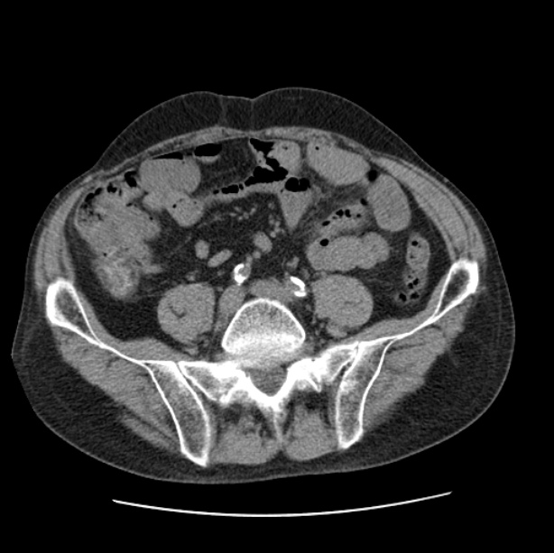 Autosomal dominant polycystic kidney disease (Radiopaedia 27851-28094 Axial non-contrast 90).jpg