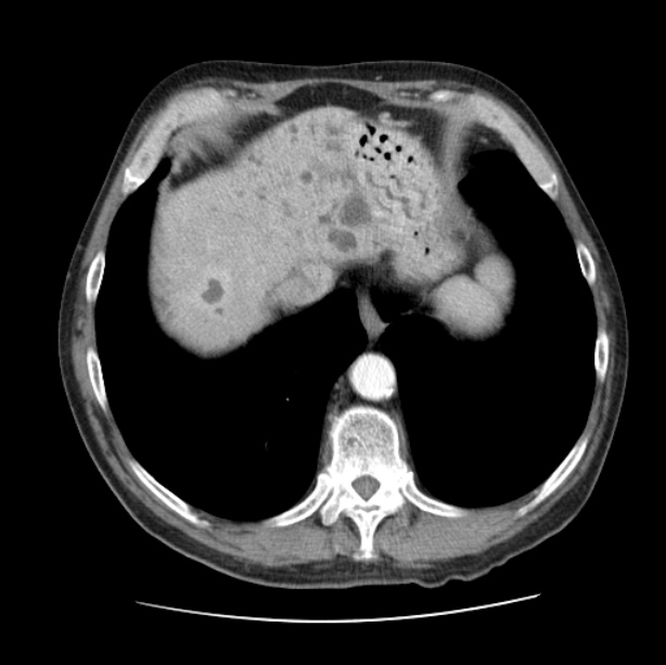 Autosomal dominant polycystic kidney disease (Radiopaedia 27851-28094 B 49).jpg