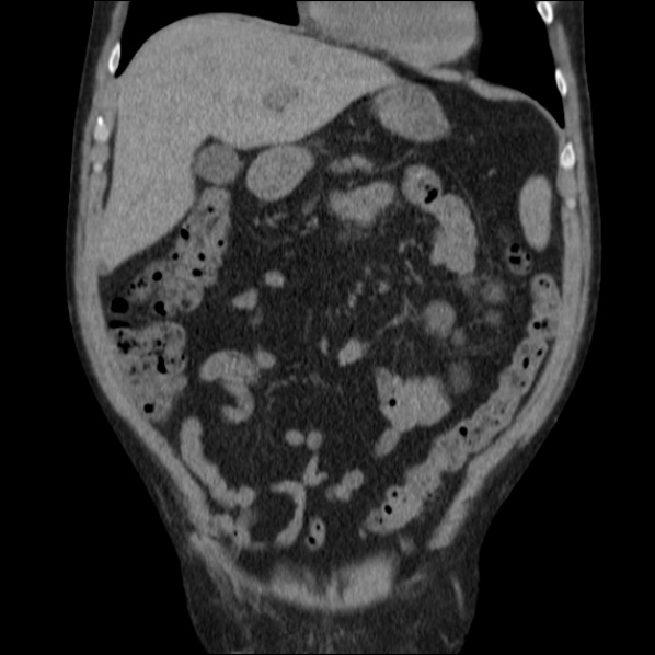 File:Autosomal dominant polycystic kidney disease (Radiopaedia 36539-38101 C 23).jpg