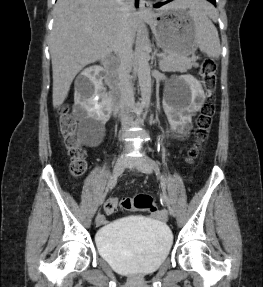 Autosomal dominant polycystic kidney disease (Radiopaedia 38189-40194 Coronal C+ delayed 45).jpg