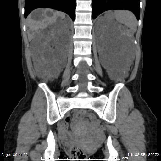 File:Autosomal dominant polycystic kidney disease (Radiopaedia 44122-47684 Coronal 20).jpg