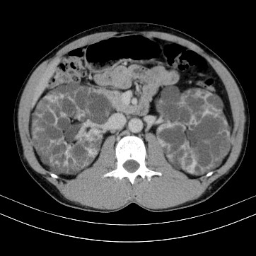 Autosomal dominant polycystic kidney disease (Radiopaedia 66349-75582 B 39).jpg