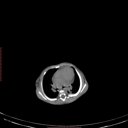 Autosomal recessive polycystic kidney disease associated with Caroli disease (Radiopaedia 61932-69984 Axial non-contrast 51).jpg