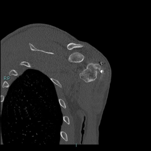 Avascular necrosis after fracture dislocations of the proximal humerus (Radiopaedia 88078-104655 Coronal bone window 100).jpg