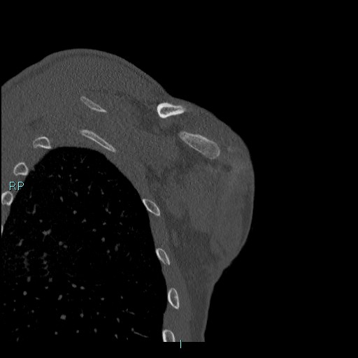 Avascular necrosis after fracture dislocations of the proximal humerus (Radiopaedia 88078-104655 Coronal bone window 111).jpg