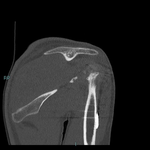 Avascular necrosis after fracture dislocations of the proximal humerus (Radiopaedia 88078-104655 Coronal bone window 60).jpg