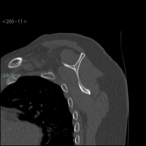 File:Avascular necrosis of the shoulder - Cruess stage I (Radiopaedia 77674-89887 Sagittal bone window 10).jpg