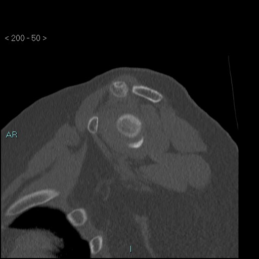 Avascular necrosis of the shoulder - Cruess stage I (Radiopaedia 77674-89887 Sagittal bone window 49).jpg