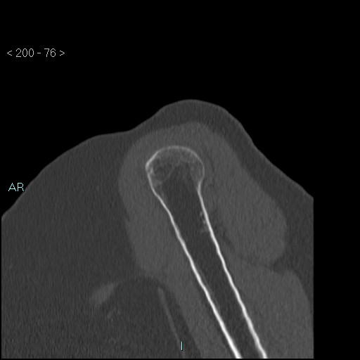 Avascular necrosis of the shoulder - Cruess stage I (Radiopaedia 77674-89887 Sagittal bone window 75).jpg