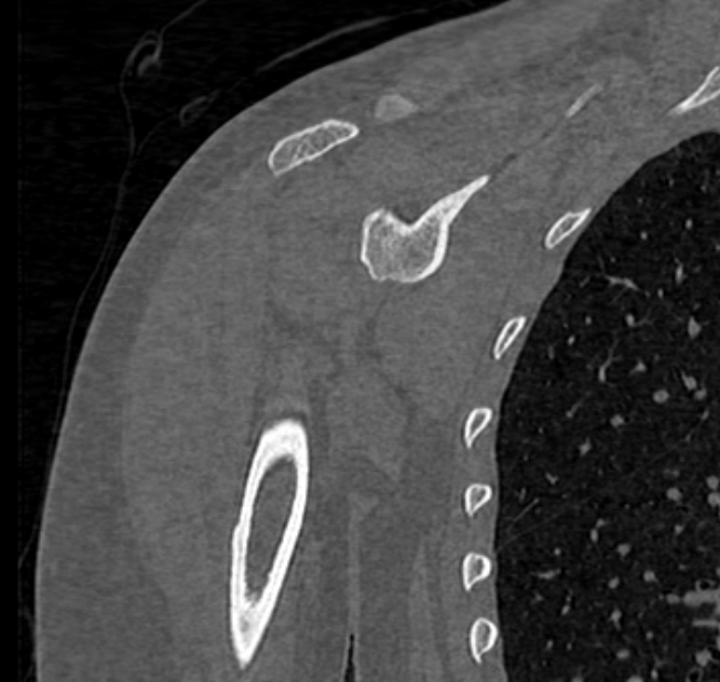 Avulsion fracture - greater tuberosity of humerus (Radiopaedia 71216-81514 Coronal bone window 38).jpg