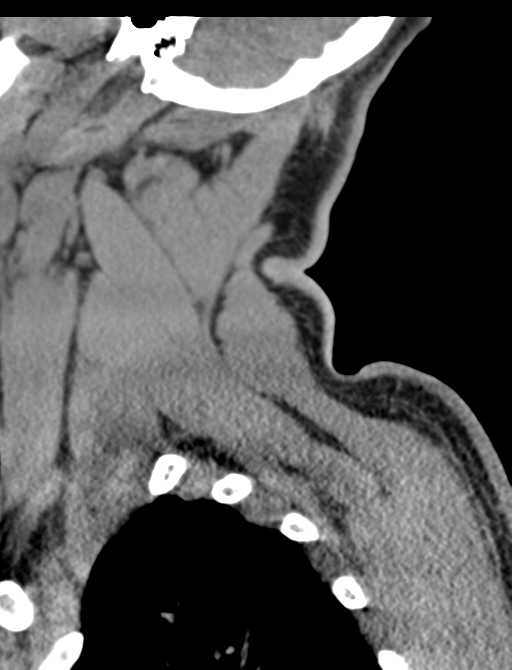 Axis peg fracture (type 3) and atlas lateral mass (type 4) fracture (Radiopaedia 37474-39324 D 6).png