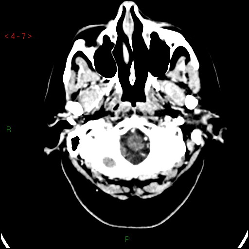 Azygos anterior cerebral artery (Radiopaedia 51987-57833 A 7).jpg