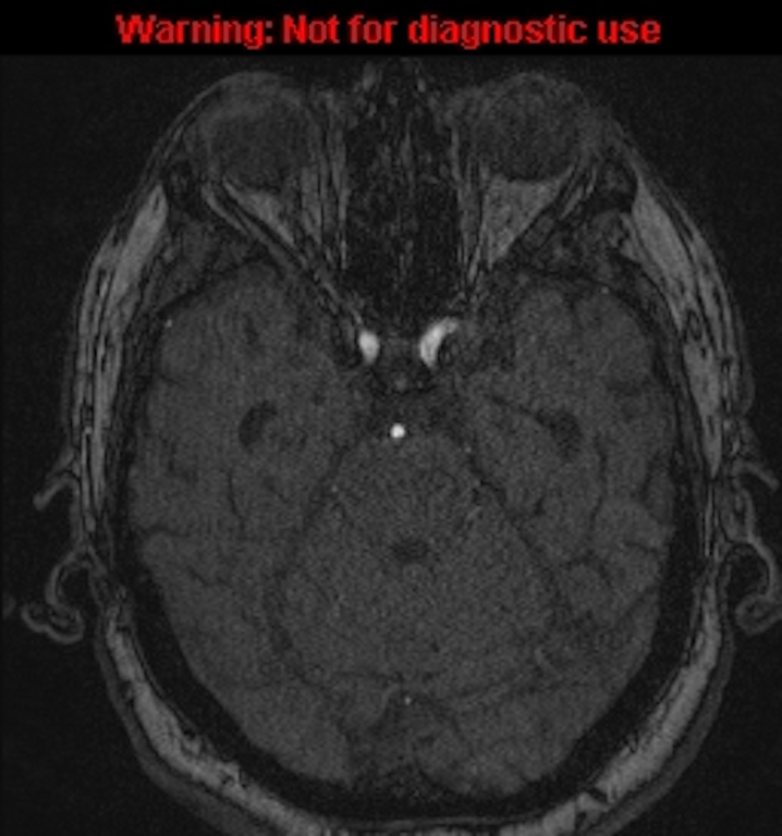 Azygos anterior cerebral artery (Radiopaedia 59325-66677 Axial MRA 53).jpg