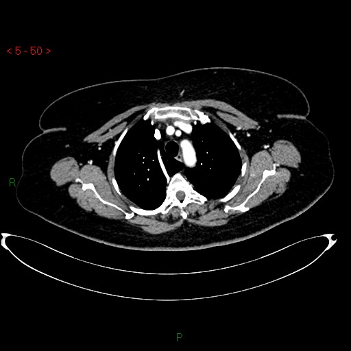 Azygos fissure and lobe (Radiopaedia 47620-52278 A 36).jpg