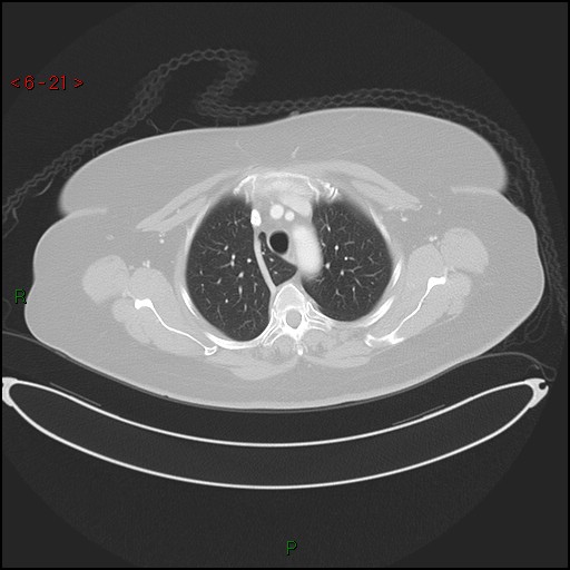 Azygos fissure and lobe (Radiopaedia 47620-52278 Axial lung window 21).jpg