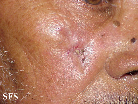 Basal Cell Carcinoma (Dermatology Atlas 103).jpg