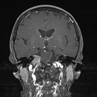 File:Base of skull chondrosarcoma (Radiopaedia 30410-31070 G 10).jpg