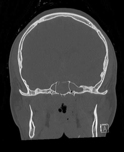 Base of skull fracture with bilateral Le Fort fractures (Radiopaedia 47094-51638 Coronal bone window 56).jpg