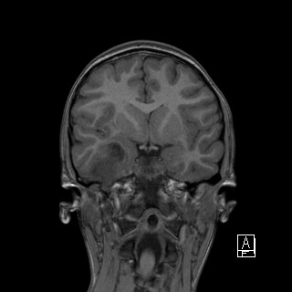 Base of skull rhabdomyosarcoma (Radiopaedia 32196-33142 Coronal T1 20).jpg