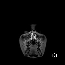 Base of skull rhabdomyosarcoma (Radiopaedia 32196-33142 I 11).jpg