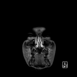 Base of skull rhabdomyosarcoma (Radiopaedia 32196-33142 I 12).jpg