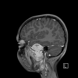 Base of skull rhabdomyosarcoma (Radiopaedia 32196-33142 J 18).jpg