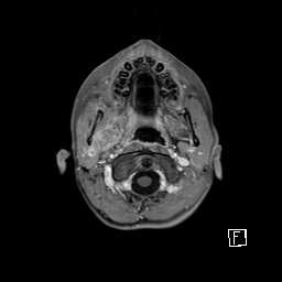 Base of skull rhabdomyosarcoma (Radiopaedia 32196-33142 T1 C+ fat sat 19).jpg