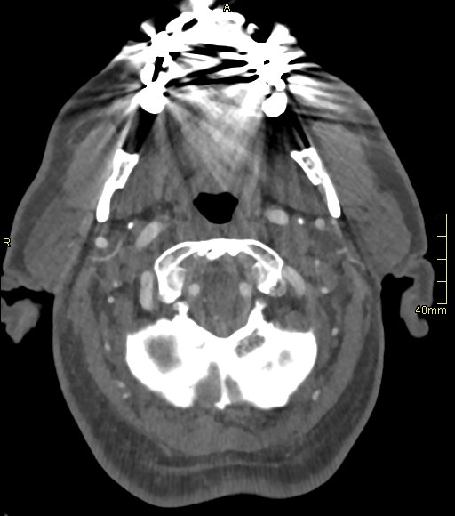 Basilar artery aneurysm (Radiopaedia 56261-62932 A 31).jpg