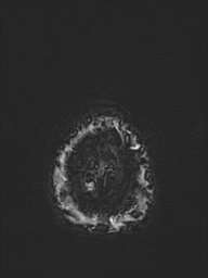 Basilar artery perforator aneurysm (Radiopaedia 82455-97733 Axial SWI 63).jpg