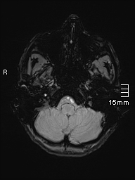 File:Basilar artery perforator aneurysm (Radiopaedia 82455-99523 Axial SWI 9).jpg