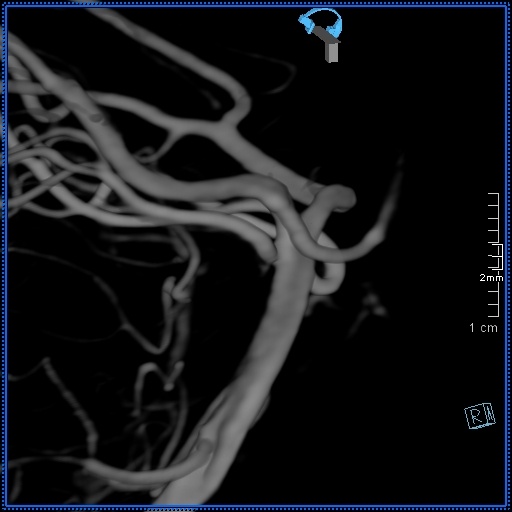 Basilar artery perforator aneurysm (Radiopaedia 82455-99524 3D Left VA 60).jpg