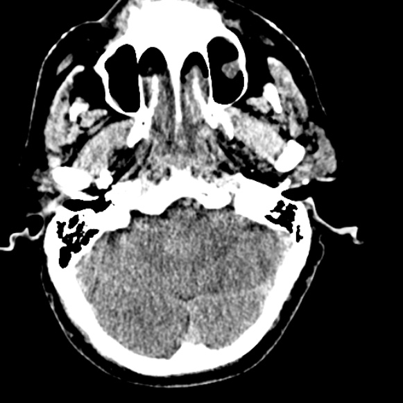 Basilar artery thrombosis (Radiopaedia 53351-59333 Axial non-contrast 35).jpg