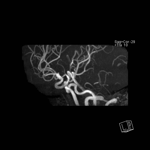 Basilar tip aneurysm (Radiopaedia 26504-26632 D 49).jpg