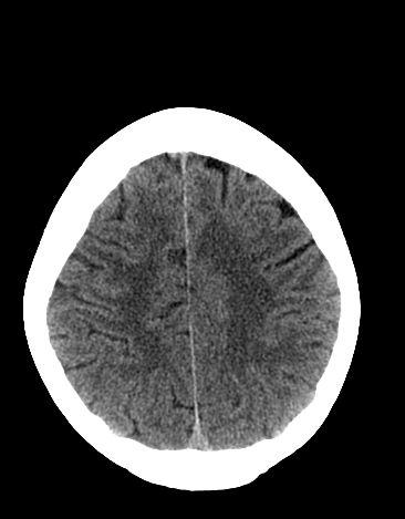 File:Basilar tip aneurysm with coiling (Radiopaedia 53912-60033 Axial 12).jpg