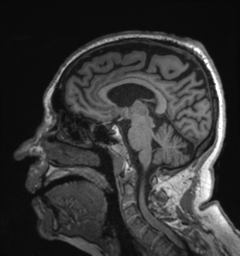 File:Behavioral variant frontotemporal dementia and late onset schizophrenia (Radiopaedia 52197-58083 Sagittal T1 54).png