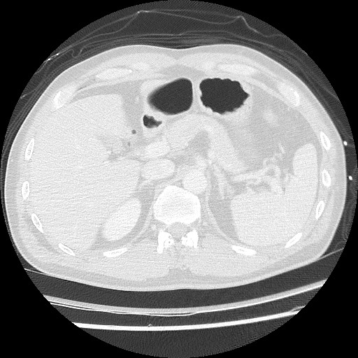 Benign post-traumatic pseudopneumoperitoneum (Radiopaedia 71199-81495 Axial lung window 70).jpg