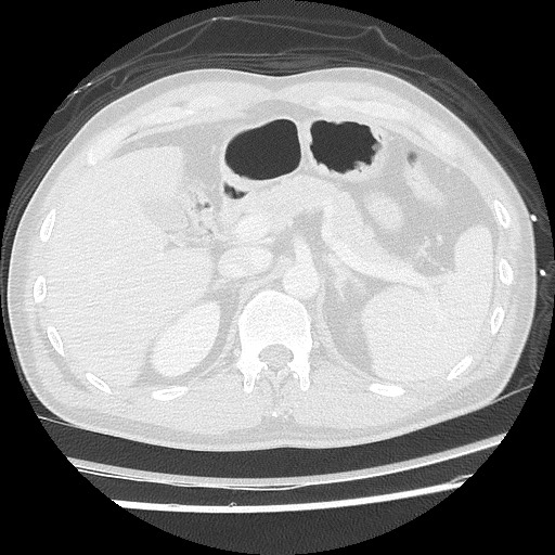 Benign post-traumatic pseudopneumoperitoneum (Radiopaedia 71199-81495 Axial lung window 71).jpg
