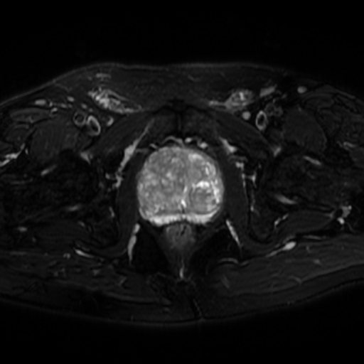 File:Benign prostatic nodular hyperplasia (Radiopaedia 16917-16634 Axial T2 fat sat 11).jpg