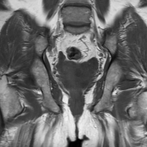 File:Benign prostatic nodular hyperplasia (Radiopaedia 16917-16634 Coronal T1 14).jpg