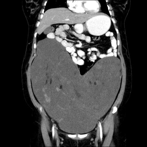 File:Benign spindle cell tumor - abdominopelvic (Radiopaedia 61300-69212 C 23).jpg