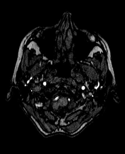 Berry aneurysm of the terminal internal carotid artery (Radiopaedia 88286-104918 Axial TOF 40).jpg
