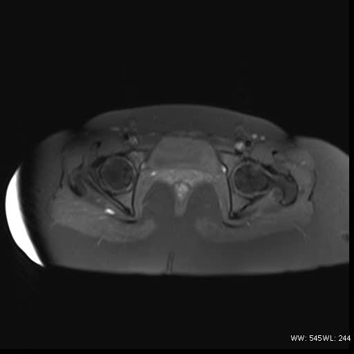 File:Bicornuate uterus- on MRI (Radiopaedia 49206-54297 Axial T1 fat sat 16).jpg