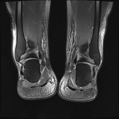 File:Bilateral Achilles tendon complete tear (Radiopaedia 81344-95051 Coronal PD fat sat 6).jpg