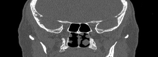 Bilateral Ectopic Infraorbital Nerves (Radiopaedia 49006-54084 Coronal bone window 63).jpg